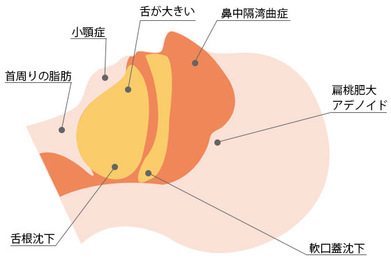 睡眠時無呼吸症候群(SAS)の分類と原因